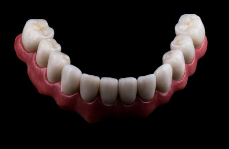 emax ceramic crowns and veneers