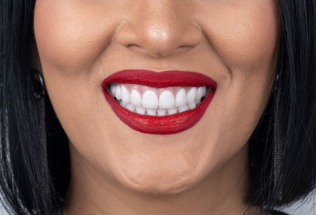 emax ceramic crowns and veneersの写真素材