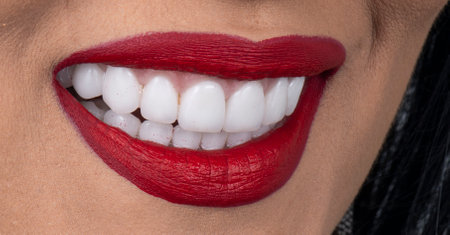 emax ceramic crowns and veneersの写真素材