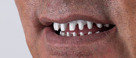 emax ceramic crowns and veneers