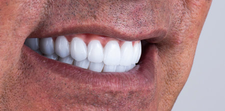 emax ceramic crowns and veneers