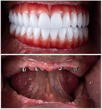 emax ceramic crowns and veneers