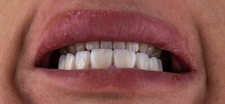 emax ceramic crowns and veneers