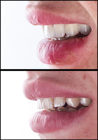 emax ceramic crowns and veneersの写真素材