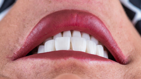 emax ceramic crowns and veneersの写真素材