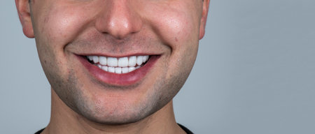 emax crowns and veneers