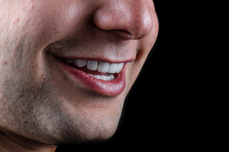 emax crowns and veneersの写真素材