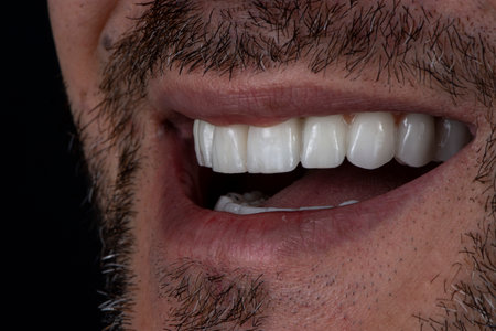 emax crowns and veneersの写真素材