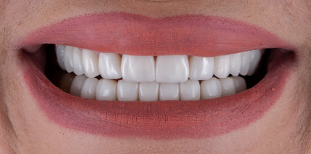emax crowns and veneersの写真素材