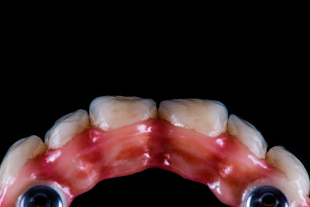 restorations on dental implantsの写真素材