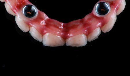 restorations on dental implants