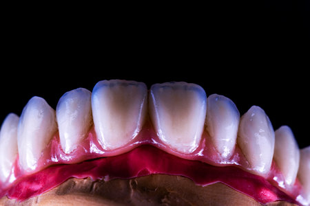 restorations on dental implants