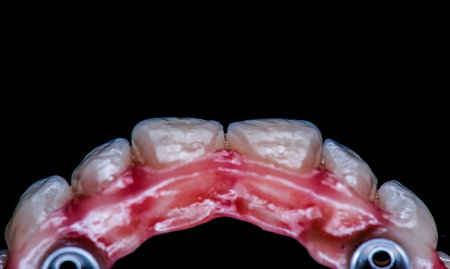 restorations on dental implantsの写真素材