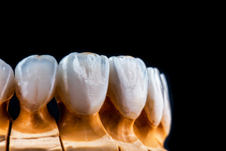 emax crowns and veneersの写真素材