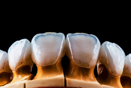 emax crowns and veneersの写真素材