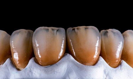 emax crowns and veneersの写真素材