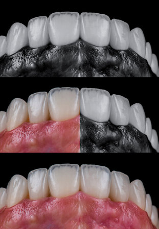 emax crowns and veneers