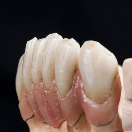 emax crowns and veneersの写真素材