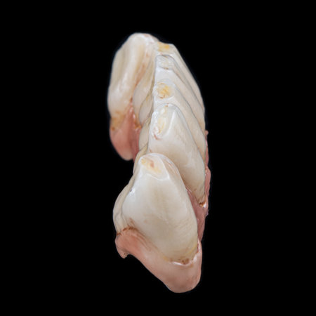 emax crowns and veneersの写真素材