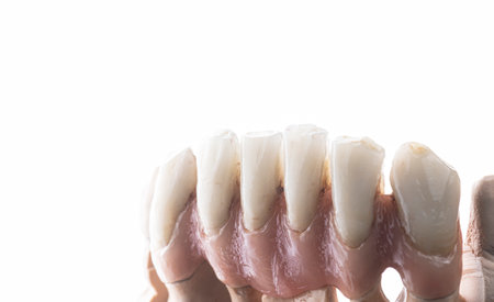 emax crowns and veneers