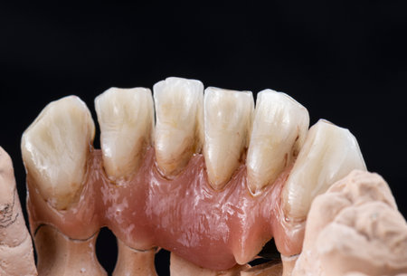 emax crowns and veneersの写真素材
