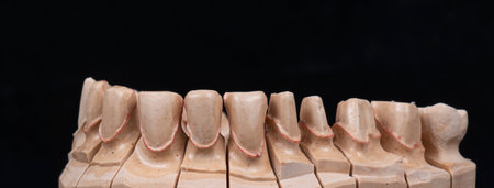 emax crowns and veneers