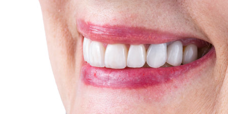 emax crowns and veneersの写真素材