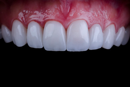 emax crowns and veneersの写真素材