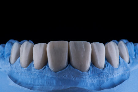 emax crowns and veneers