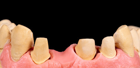 emax crowns and veneers