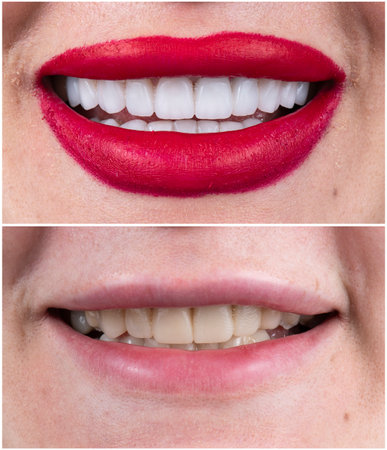 emax crowns and veneersの写真素材