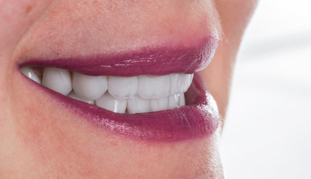 emax crowns and veneers