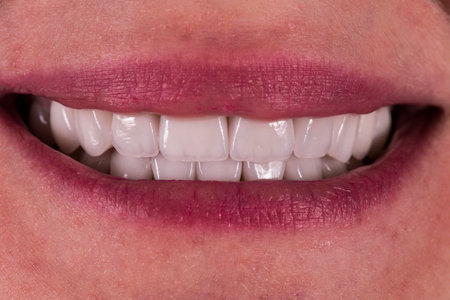 emax crowns and veneers