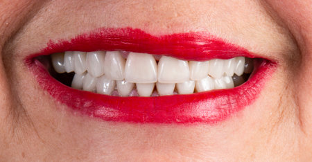 emax crowns and veneersの写真素材