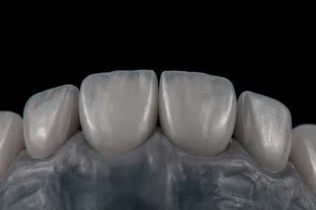 emax ceramic veneers b1 color