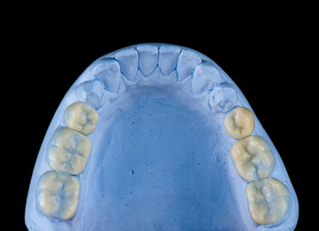 Emax ceramic crowns and veneers like natural teeth