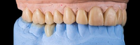 Emax ceramic crowns and veneers like natural teethの写真素材