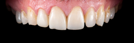 Emax ceramic crowns and veneers like natural teethの写真素材