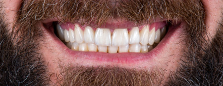 Emax ceramic crowns and veneers like natural teeth
