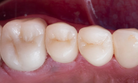 Emax ceramic crowns and veneers like natural teethの写真素材