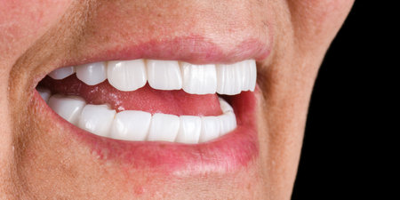 emax ceramic bridge on implantsの写真素材