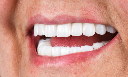 emax ceramic bridge on implantsの写真素材