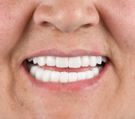 emax ceramic bridge on implantsの写真素材