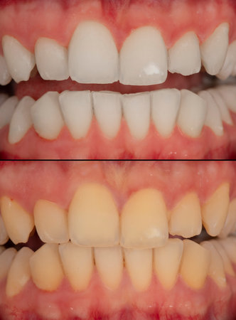 teeth whitening before and after picture