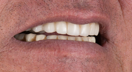 Emax ceramics on hybrid implant bridgeの写真素材
