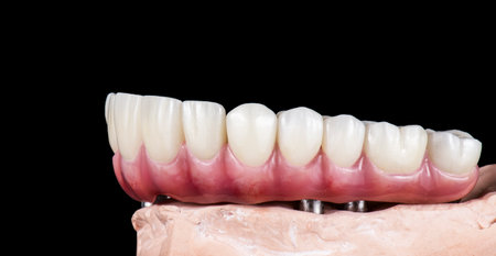 Emax ceramics on hybrid implant bridgeの写真素材