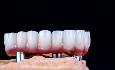 dental photography of full arch zircon bridge on implantsの写真素材