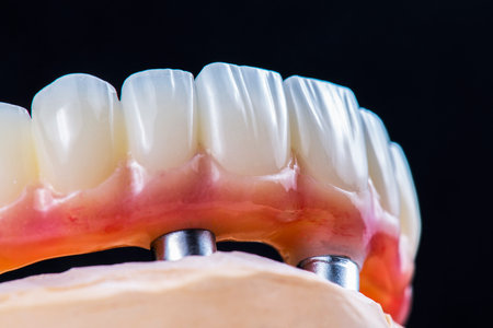 dental photography of full arch zircon bridge on implantsの写真素材