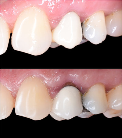 old crown replacing with new zirkon crownの写真素材