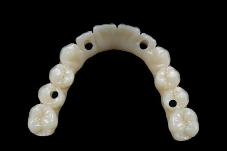 emax natural look crowns on implants